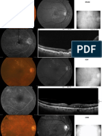 retinopatias