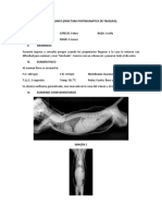 Fractura Postraumatica de Traquea