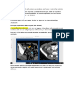 Tomografía de abdomen: hallazgos en apendicitis, diverticulitis y otras patologías abdominales