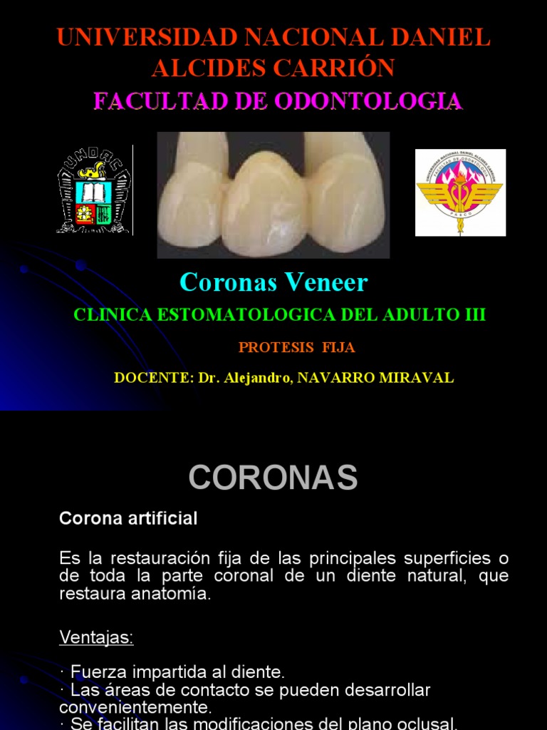 Coronas Veneer