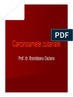 Carcinoamele Cutanate