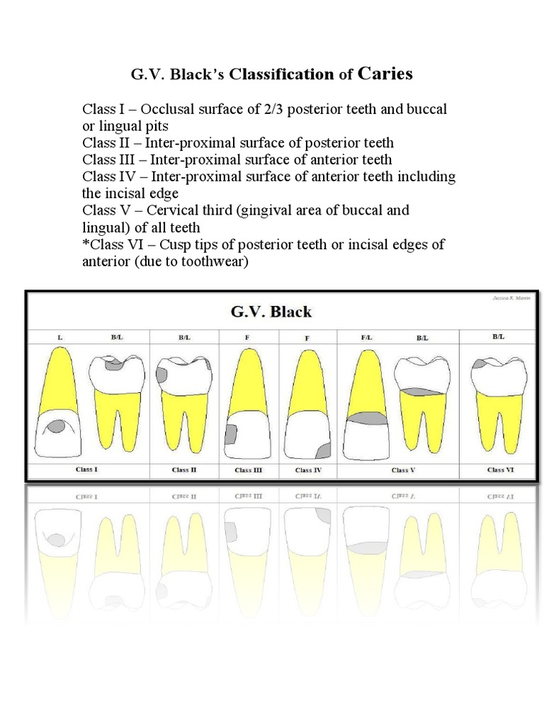 G.v Black Caries Classification