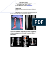 Treatment of Tibial Congenital Pseudarthrosis by Medial Transport of Fibula With Ilzarov Method. Nuno Craveiro Lopes