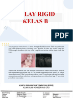 Onlay Rigid Kelas B