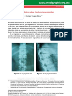 Caso Clinico Sobre Fractura Toracolumbar