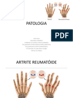 Artrite Reumatóide: Sintomas, Causas e Tratamento