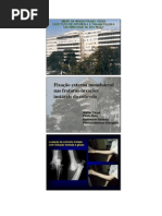Fixação externa monolateral nas fraturas-luxaluxações instáveis do cotovelo. Walter Targa, Paulo Reis, Guilherme Gaiarsa, Patricia Moreno Grangeiro