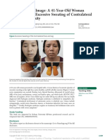 Teaching Neuroimage: A 41-Year-Old Woman Presented With Excessive Sweating of Contralateral Face and Extremity