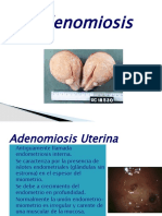 Adenomiosis