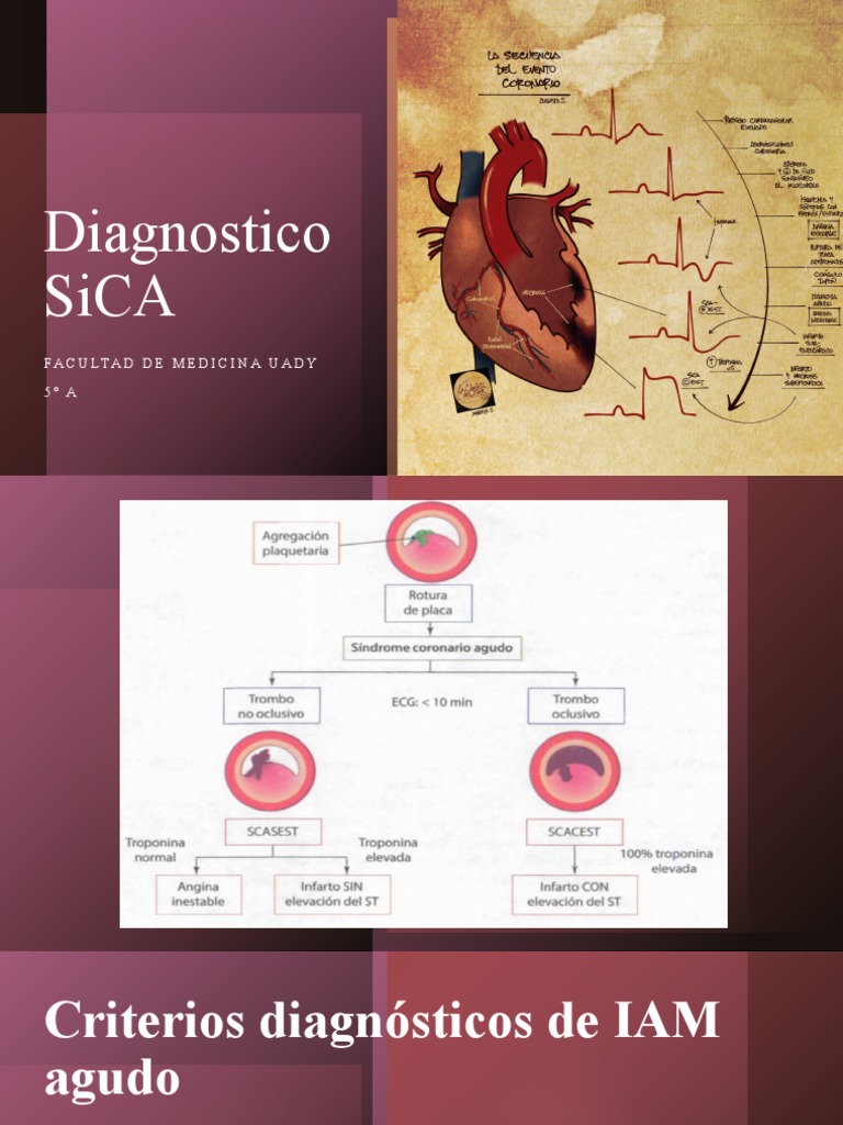 Diagnóstico y Manejo del SICA | PDF | Infarto de miocardio ...