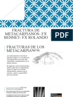 FRACTURA DE METACARPIANOS - FX BENNET - FX ROLANDO FVP