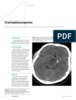 Craniopharyngioma: Case Summary