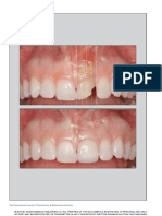 Extraction Site Management in the Esthetic Zone Using Autogenous Hard and Soft Tissue Grafts- A 5-Year Consecutive Clinical Study