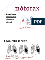 Hemotorax