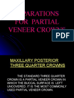 Preparations for Maxillary Posterior Partial Veneer Crowns