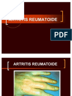 03 - Artritis Reumatoidea