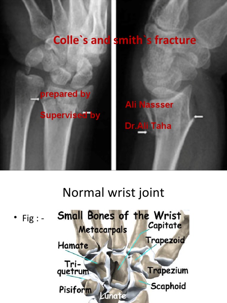 Colle's and Smith's Fracture: Prepared by Ali Nassser Supervised by DR ...