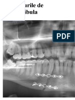 Fracturile de mandibula