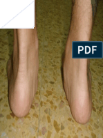 Pie plano del adulto por rotura del tibial posterior