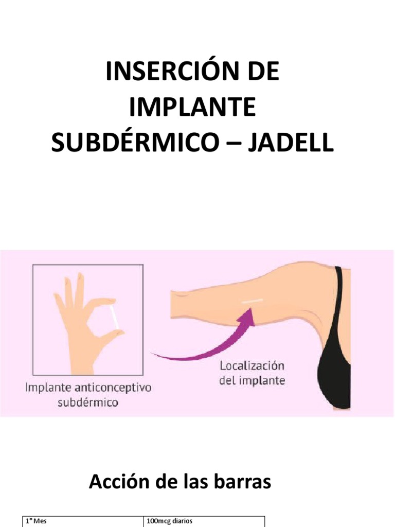 Guía sobre el Implante Subdérmico Jadelle | PDF