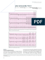 ECG Series: Narrow QRS-complex tachycardia: Part 2