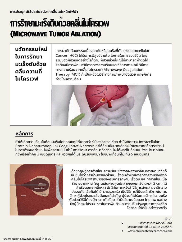 Microwave Tumor Ablation | PDF