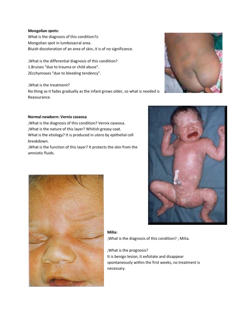 Mongolian Spots PDF Infants Candidiasis