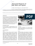 First Trimester Ultrasound Diagnosis of Holoprosencephaly Three Case Reports