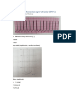 Serie de Fourier Patología Cardiaca TSVP