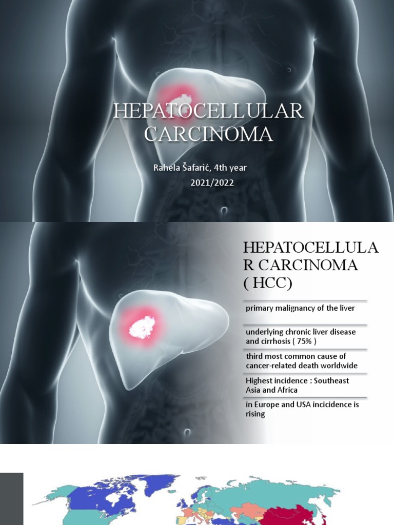 Understanding Hepatocellular Carcinoma | PDF | Hepatitis | Hepatitis C