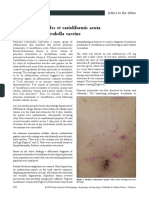 Pityriasis Lichenoides Et Varioliformis Acuta Following Measles Rubella Vaccine