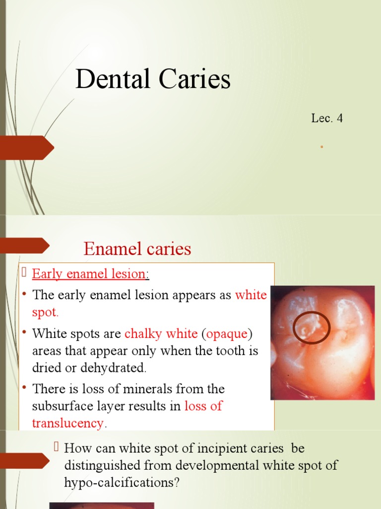 Dental Caries Lect 4 | PDF | Tooth Enamel | Dentin