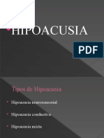 Hipoacusia