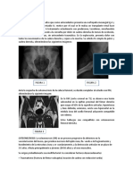 Caso Clinico Cadera