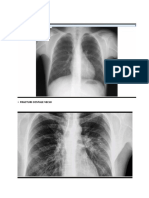 Sdr. Parietal+Pleural