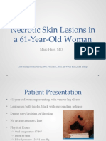 Necrotic Skin Lesions in a 61-Year-Old Woman with Cryoglobulinemia