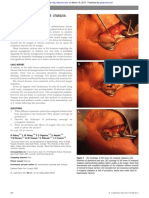 Management of Marginal Chalazia: A Surgical Approach: Education