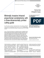 Minimally invasive condylectomy with 3D printed guide