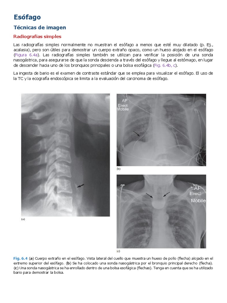 Radiología Del Esófago | PDF | Cáncer de esófago | Esófago