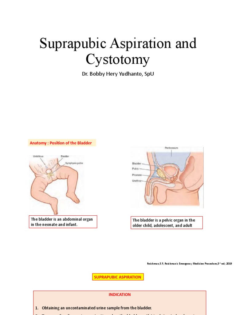 Suprapubic Aspiration and Cystotomy Guide | PDF | Urinary Bladder | Abdomen