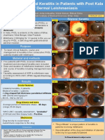 Miltefosine Induced Ring Keratitis in PKDL Patients