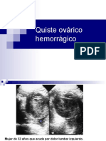 Quiste Ovrico Hemorrgico Copy2