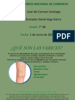 Varices: causas, síntomas y tratamientos