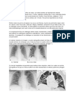 Caso Clínico COVID