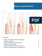 What is Periodontitis