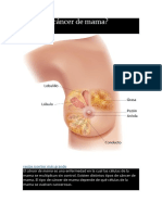 Qué Es El Cáncer de Mama