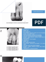 Nasopalatine Duct Cyst