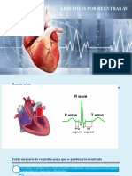 Arritmias Por Reentras AV