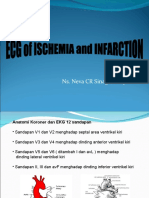 ECG of ACS