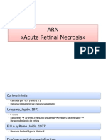 ARN Acute Retinal Necrosis